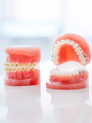 types of braces